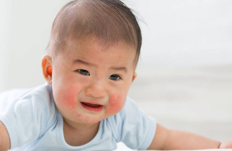 Trądzik niemowlęcy, trądzik noworodkowy i rumień – przyczyny, objawy, leczenie