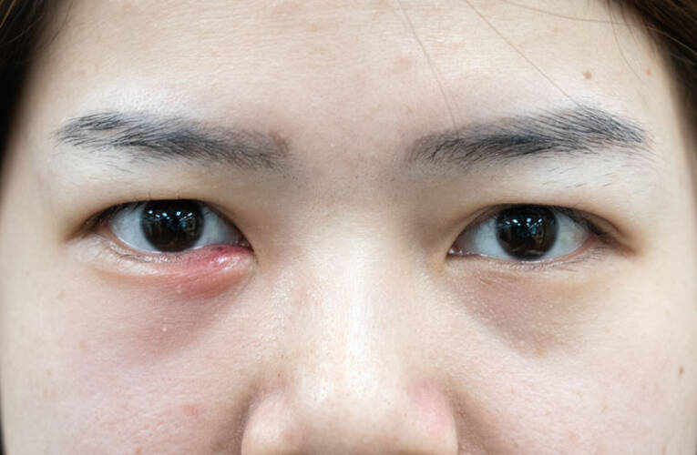 Jęczmień na oku – jak rozpoznać? Jak leczyć? Co to jest?