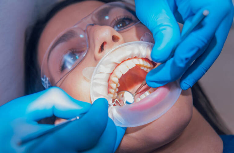Skaling zębów – co to jest i kiedy warto zrobić?